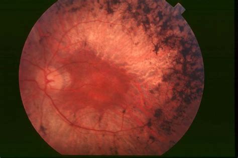 retinosis pigmentaria - resultado do jogo do bahia